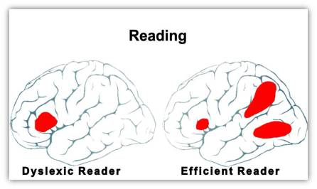 perbedaan otak penderita disleksia dan otak normal